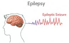 It’s not always possible to recognize a seizure. Not all the seizures include the unusual movements of the muscle or convulsion.  So to educate the masses about its sign and symptoms, 17th November is observed as National Epilepsy Day.
Kindly read our blog at the following link to have a complete insight on Stroke and also read the messages from #DrSoniaLalGupta, Consultant - Neurology, Metro Hospitals & Heart Institute, Noida. 
https://metrogroupofhospitals.blogspot.in/2017/11/national-epilepsy-day-understanding.html763136