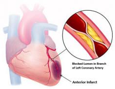 If we talk in simple language, coronary artery disease is also known as coronary heart disease or heart disease. It is one of the most consequential heart conditions as the arteries of the heart gets blocked because of the deposition and formation of plaque in the arteries. Read our article at the following link:
https://bit.ly/2wDZjn8
