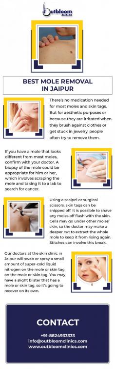 The skin tags can be snipped off with surgical scissors and a scalpel because some moles on your face diminish your looks. The medical service of mole tag removal in Jaipur and other areas can help you maintain your skin condition. 
Don’t worry if you want to look promising, fresh, and beautiful. The medical experts in Outbloomclinics can help in managing the healthy condition of your face. Look radiant and aesthetic with the help of medical science. Contact us today! 

For more info visit here: https://www.outbloomclinics.com/mole-skin-tags-removal/