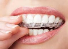 Invisalign Provider Century City: Your Guide to Expert Orthodontic Care
Achieving a straighter and healthier smile starts with choosing the right Invisalign specialist for your dental needs. Patients searching for the best Invisalign provider Century City has to offer often look for experienced professionals who combine advanced technology with personalized orthodontic care. Invisalign treatment provides a modern and discreet way to improve smile alignment without the discomfort of traditional braces.
Choosing a trusted Invisalign dentist Century City patients rely on can make a significant difference in your smile transformation journey. Professional Invisalign providers create customized aligners designed to gradually move teeth into proper alignment while maintaining comfort and convenience throughout the treatment process.
Many people searching for an Invisalign dentist near them want a treatment option that fits easily into their daily lifestyle. Invisalign aligners are removable, nearly invisible, and designed for comfort, making them a preferred choice for adults and teens seeking a more flexible orthodontic solution.
Working with an experienced Invisalign orthodontist near them allows patients to receive accurate evaluations and carefully planned treatment strategies. From correcting crowded teeth to improving bite alignment, Invisalign technology can address a wide range of orthodontic concerns with precision and efficiency.
Patients interested in modern smile correction often choose the best Invisalign provider Century City residents trust because of the personalized attention and advanced digital scanning technology used during treatment planning. Customized aligners help improve comfort while supporting predictable and effective smile results over time.
A qualified Invisalign dentist Century City residents trust can guide patients through every stage of treatment while helping them maintain excellent oral health. Regular monitoring and professional support ensure the aligners continue working effectively and comfortably throughout the process.
Ready to improve your smile with advanced clear aligner treatment? Check our location in Century City and connect with a trusted Invisalign provider for personalized orthodontic care designed to deliver confident and long-lasting results.