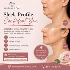Achieve a slimmer, more sculpted profile with professional double chin reduction treatments in San Mateo. Rose Wellness & Spa provides advanced, non-invasive solutions that target stubborn fat beneath the chin, tighten loose skin, and enhance jawline definition. Our customized treatments are designed to create a smoother, more youthful appearance without surgery or downtime. Whether your double chin is caused by aging, genetics, or weight changes, our experienced specialists deliver personalized care to help you look and feel your best.