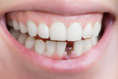 Dental implants in Perth are the most advanced solution for tooth replacement, offering a natural-looking and fully functional alternative to missing teeth. Unlike traditional dentures or bridges, implants replace the visible tooth and its root. The implant post, made from biocompatible titanium, fuses with the jawbone, creating a strong foundation for an artificial tooth. This integration process ensures a secure and stable restoration that mimics the function of natural teeth.